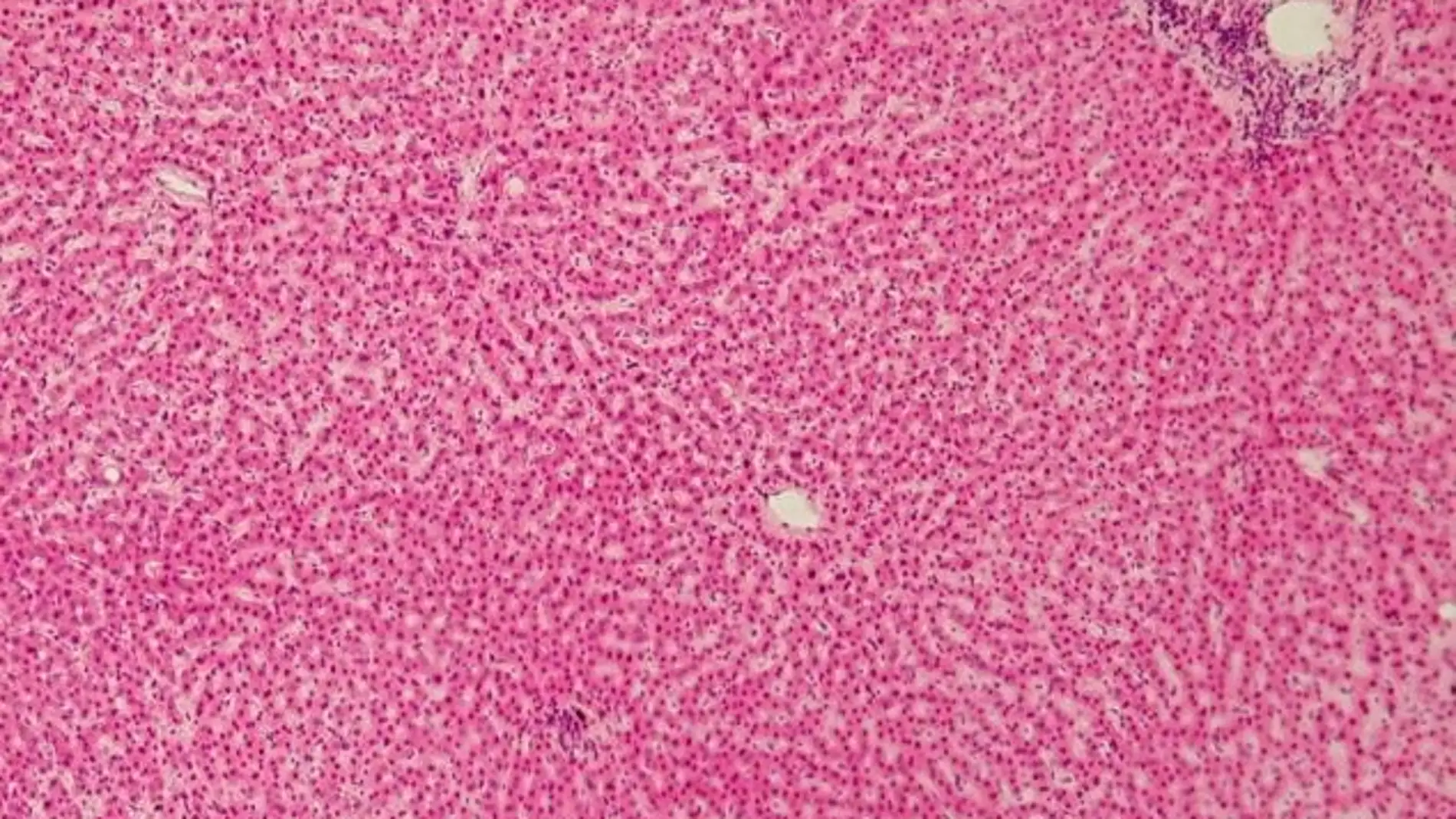Relacion entre riesgo de infeccion bacteriana y muerte tras un trasplante de higado