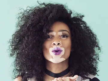 La modelo con vitiligo Winnie Harlow La modelo con vitiligo Winnie Harlow