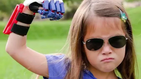 Niña de 7 años con prótesis impresa en 3D en su mano derecha Niña de 7 años con prótesis impresa en 3D en su mano derecha