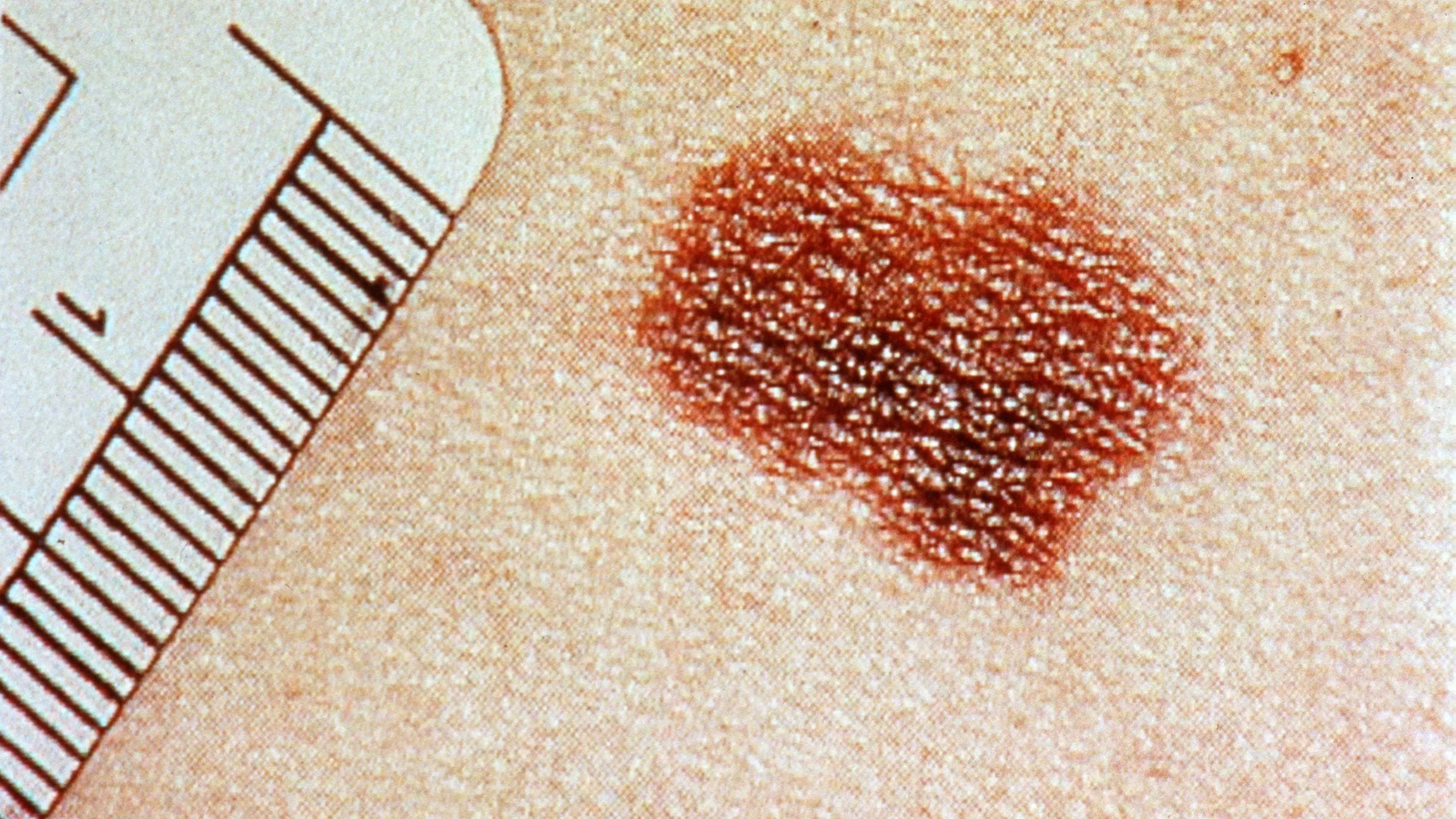 Melanoma