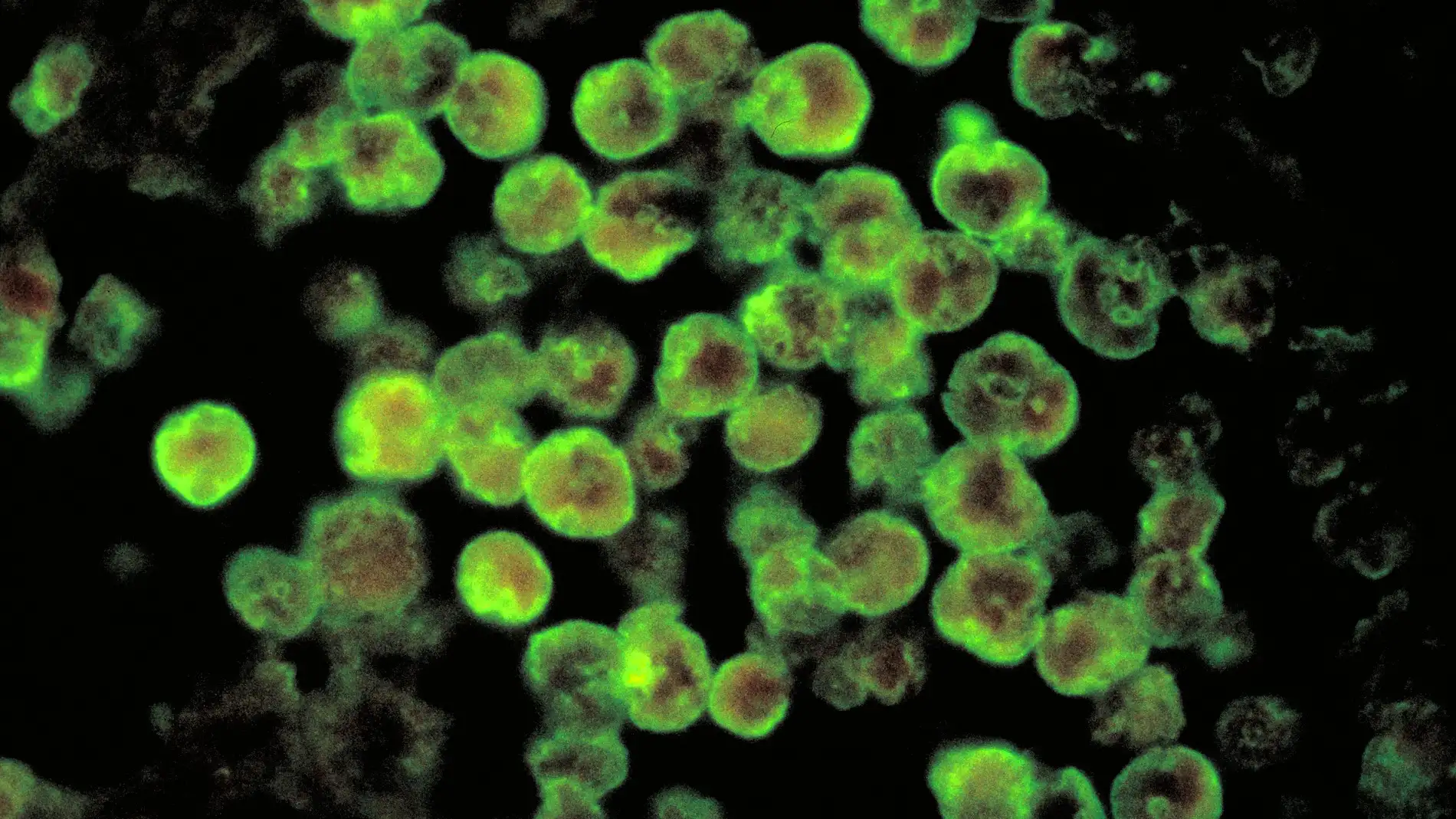 Histopatologia de la meningoencefalitis amébica