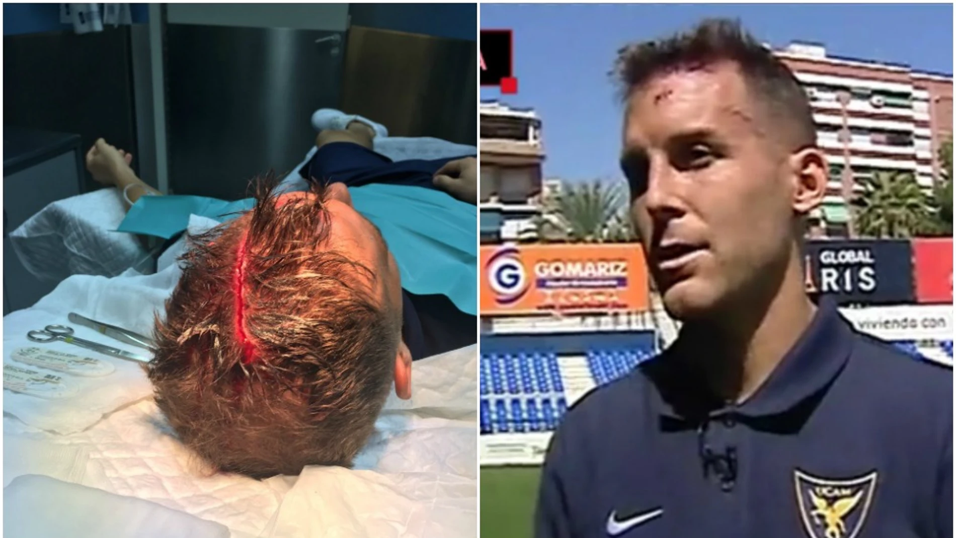 Góngora, el jugador del UCAM Murcia que sufrió una escalofriante herida en la cabeza