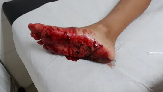 Heridas en el pie que presenta el niño Heridas en el pie que presenta el niño