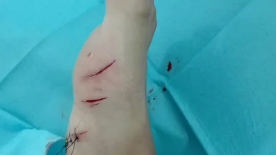 Heridas en el pie que presenta el niño Heridas en el pie que presenta el niño