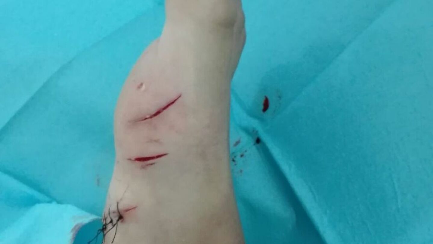 Heridas en el pie que presenta el ni&ntilde;o