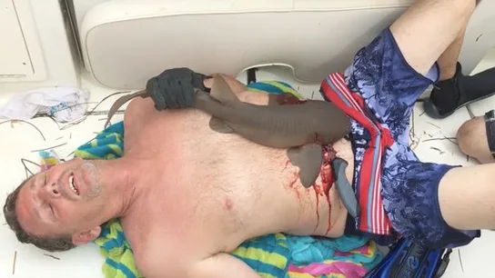 El tiburón que mordió a un hombre en el abdomen El tiburón que mordió a un hombre en el abdomen