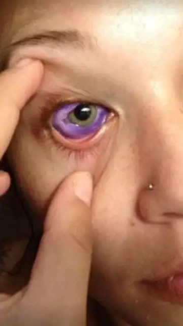 Cat Gallinger, tras el tatuaje en su ojo Cat Gallinger, tras el tatuaje en su ojo