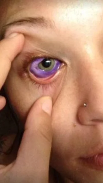 Cat Gallinger, tras el tatuaje en su ojo