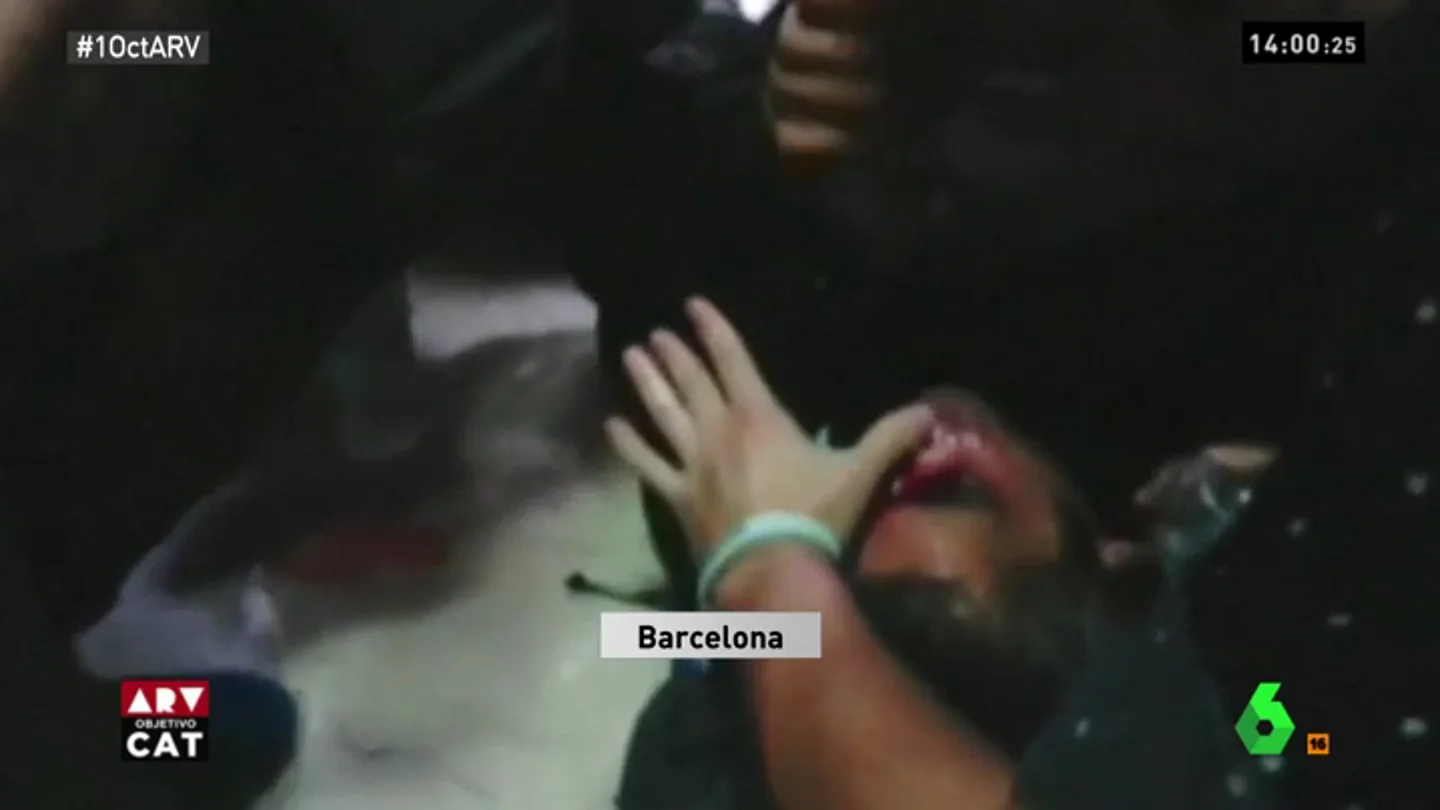 Herido en el ojo por una pelota de goma disparada por la Policía Nacional durante el 1-O Herido en el ojo por una pelota de goma disparada por la Policía Nacional durante el 1-O