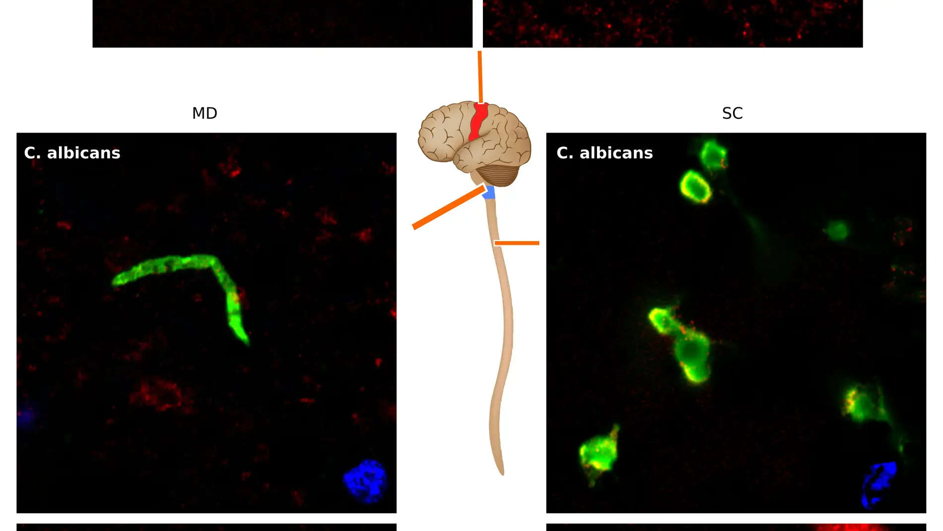 Investigadores espanoles relacionan la ELA con hongos en el cerebro