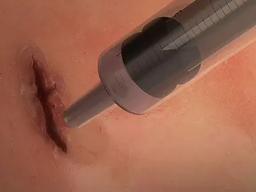 El pegamento es inocuo y puede ser absorbido sin problema por los tejidos El pegamento es inocuo y puede ser absorbido sin problema por los tejidos