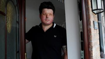 Andreas Christopheros, víctima de un ataque con ácido en Reino Unido