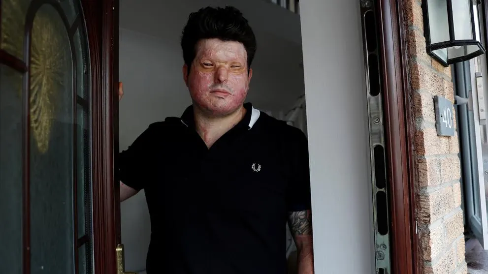 Andreas Christopheros, víctima de un ataque con ácido en Reino Unido Andreas Christopheros, víctima de un ataque con ácido en Reino Unido