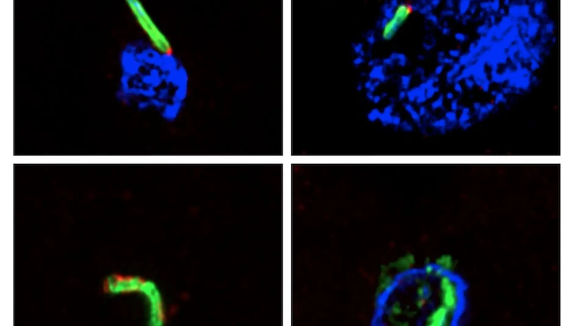 Nuevas infecciones microbianas en cerebros de personas fallecidas por alzheimer