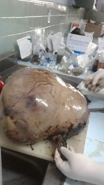 El fibroma de 10 kilos extraído de la barriga de la mujer. El fibroma de 10 kilos extraído de la barriga de la mujer.