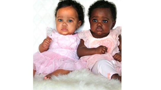 Foto de las gemelas con tonos de piel distintos