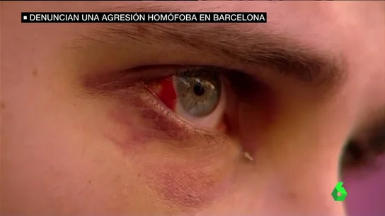 Joven víctima de una agresión homófoba Joven víctima de una agresión homófoba