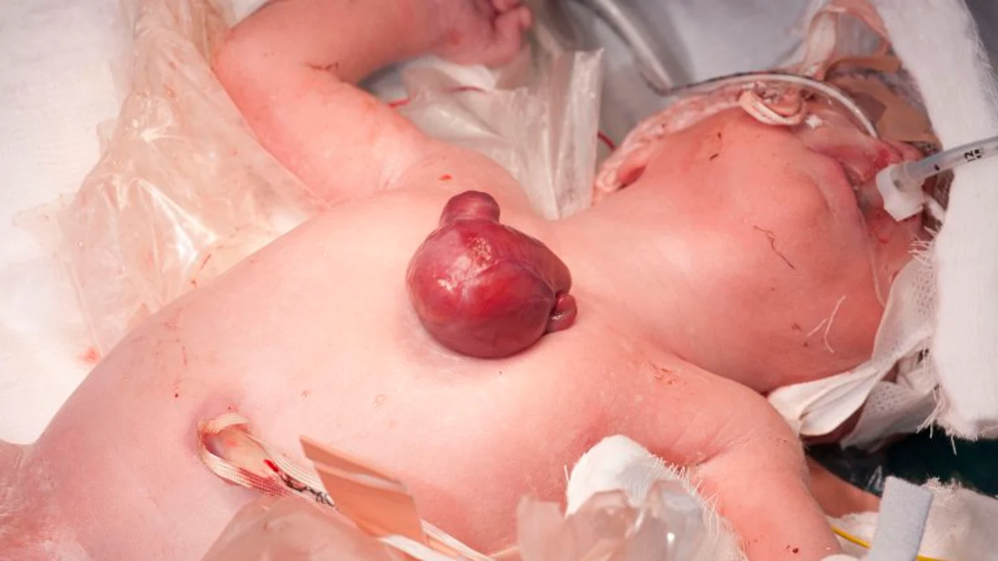 Una bebé nacida con el corazón fuera del pecho La bebé británica que nació con el corazón fuera del pecho