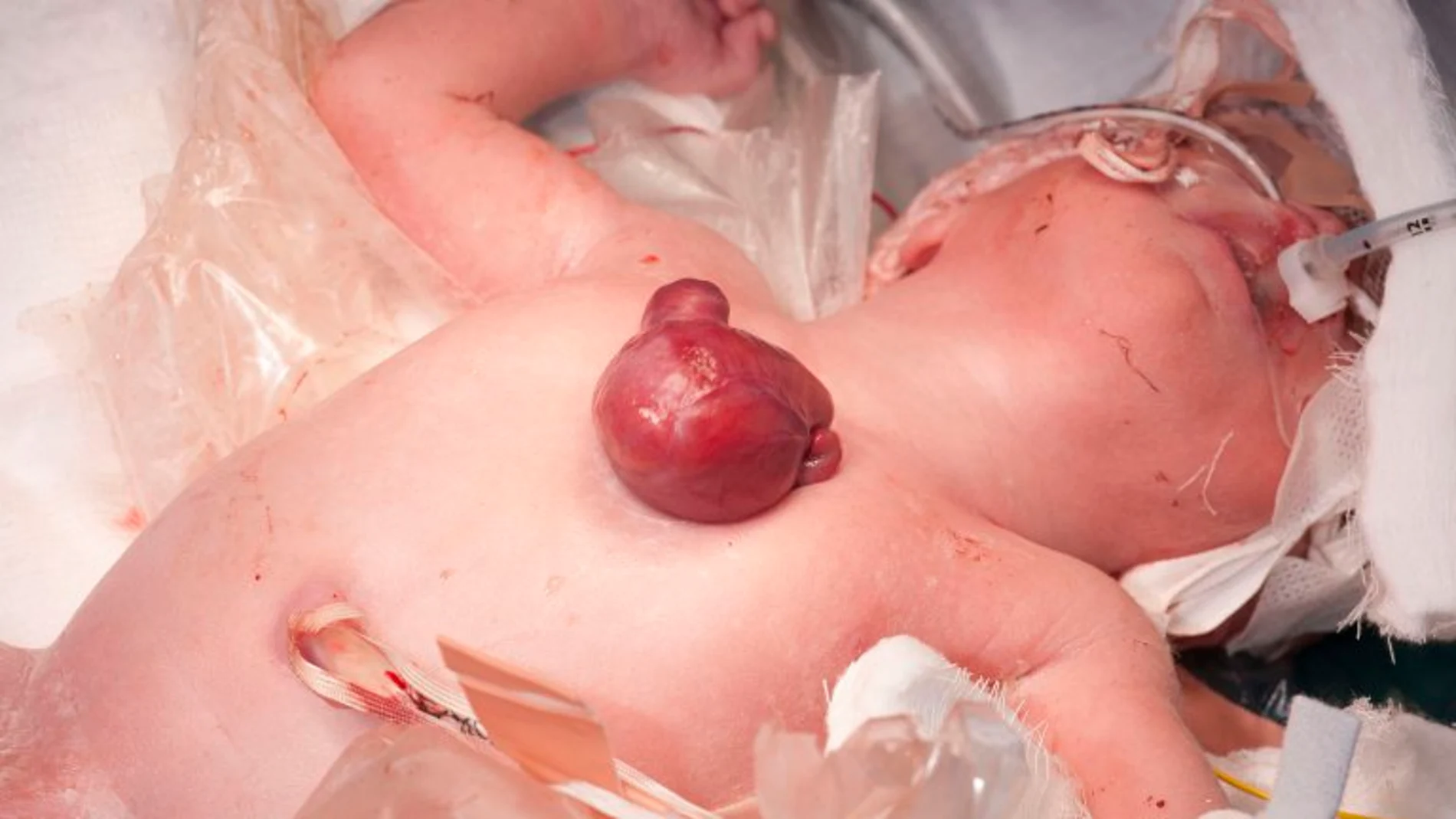 Una bebé nacida con el corazón fuera del pecho
