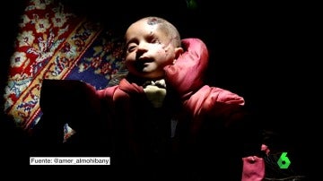 El símbolo de las víctimas de Al Assad: Karim, un bebé que perdió el ojo