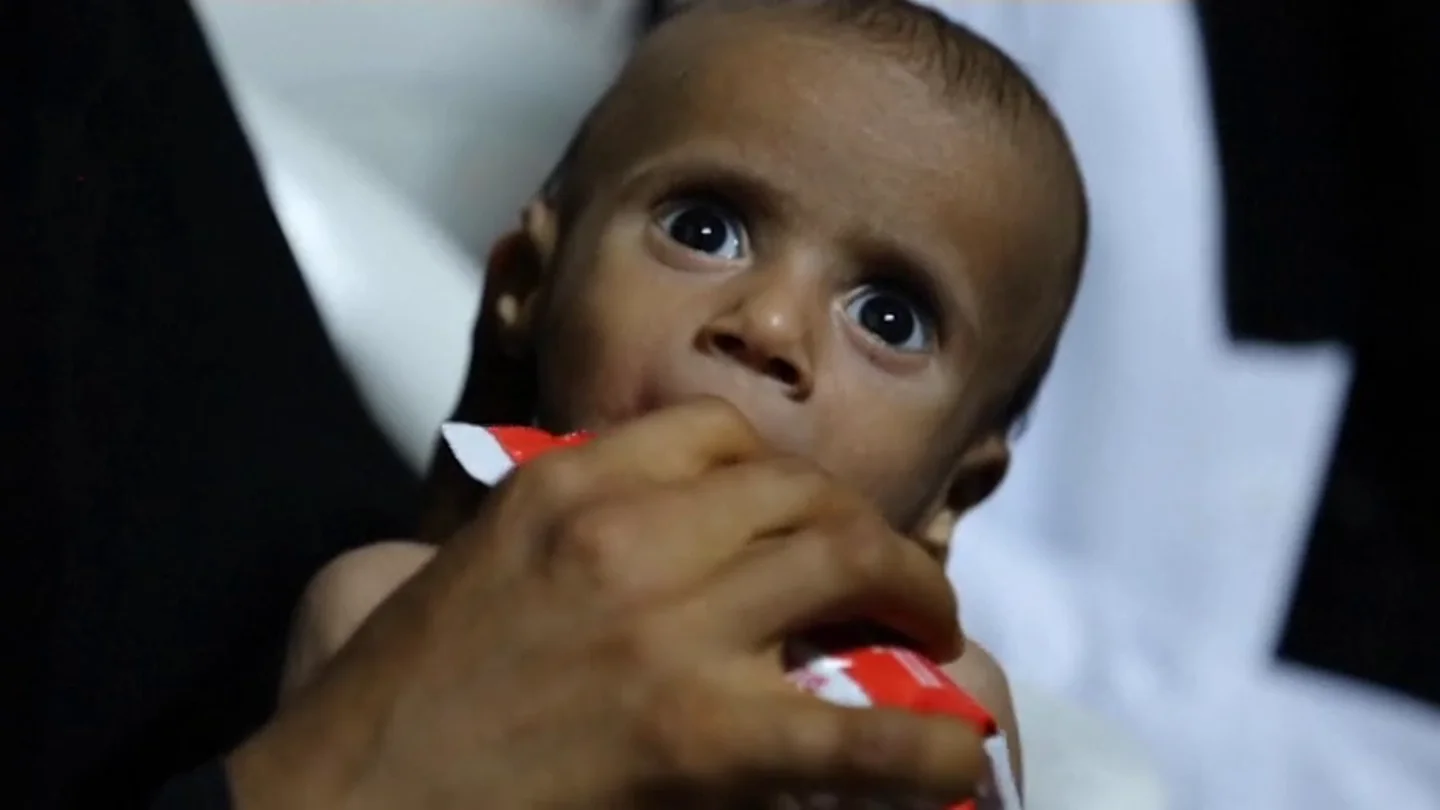 Víctimas al borde de la hambruna tras 1.000 días de guerra en Yemen Víctimas al borde de la hambruna tras 1.000 días de guerra en Yemen
