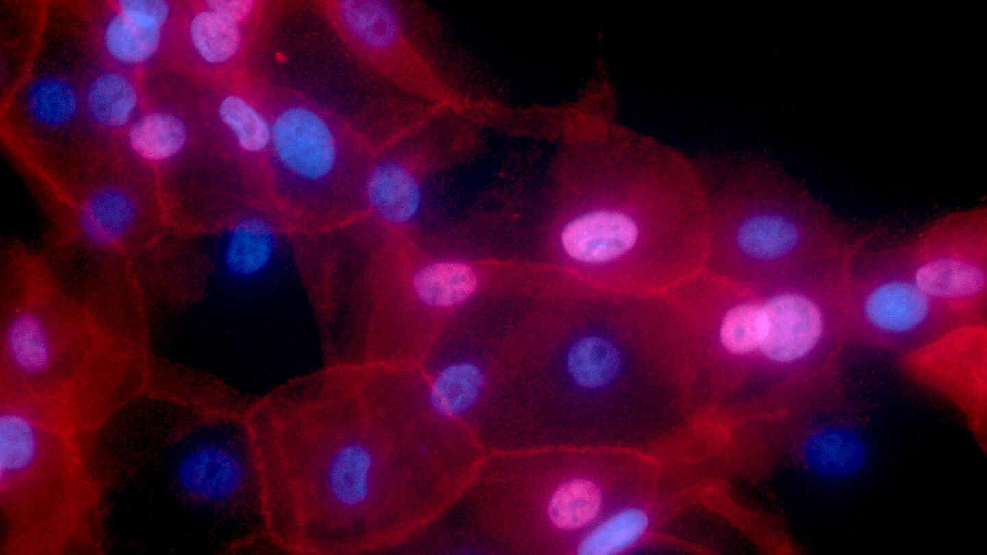 C&eacute;lulas de c&aacute;ncer de mama cultivadas en laboratorio