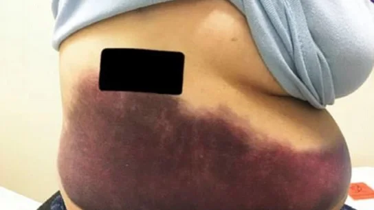 Una anciana se rompe una costilla por un fuerte ataque de tos Una anciana se rompe una costilla por un fuerte ataque de tos