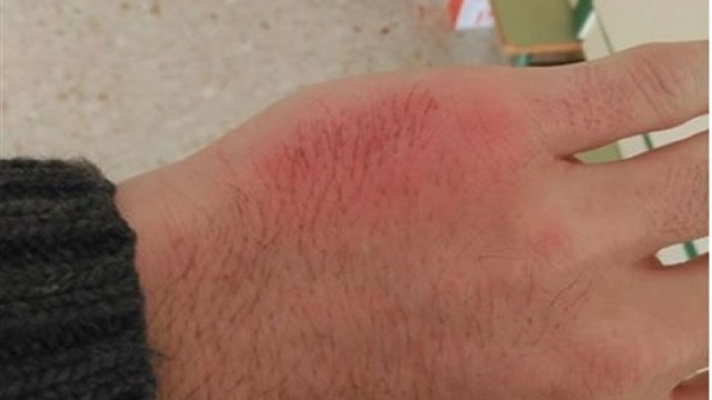 Inflamaci&oacute;n por una agresi&oacute;n de un alumno 