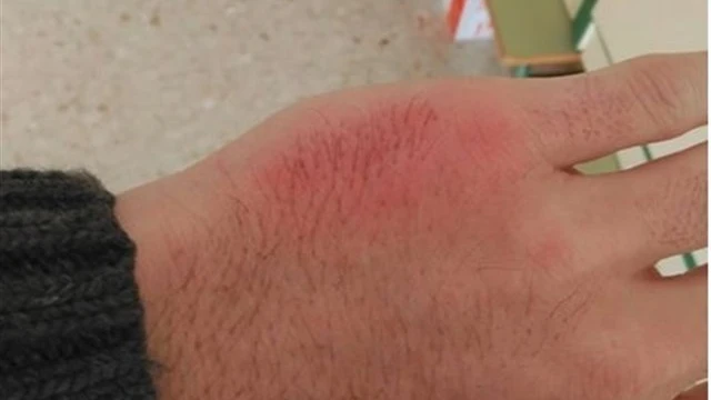 Inflamación por una agresión de un alumno Inflamación por una agresión de un alumno