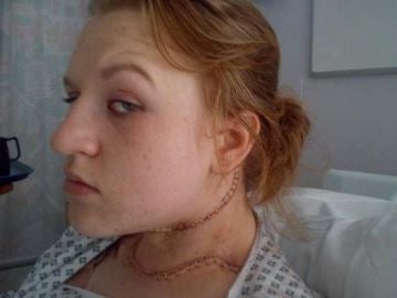 Cerys Head, tras ser operada de cáncer de tiroides Cerys Head, tras ser operada de cáncer de tiroides