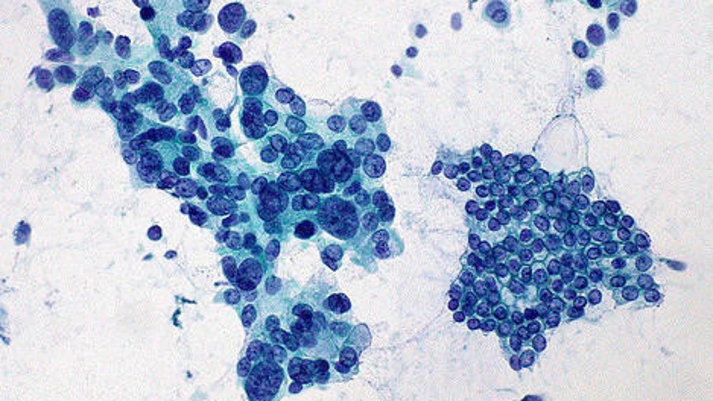 El estudio de un gen abre una nueva puerta a la prevencion del cancer de pancreas El estudio de un gen abre una nueva puerta a la prevencion del cancer de pancreas