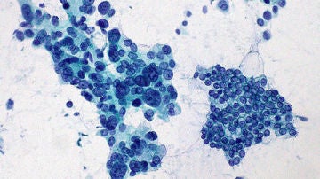 El estudio de un gen abre una nueva puerta a la prevencion del cancer de pancreas