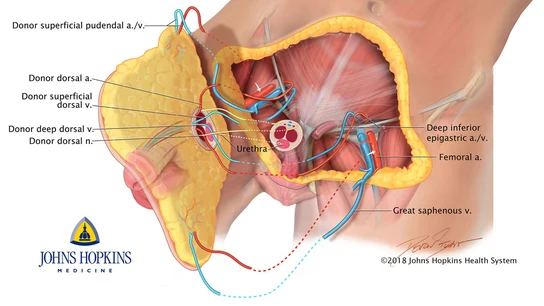 Dibujo del primer trasplante de pene y escroto Dibujo del primer trasplante de pene y escroto