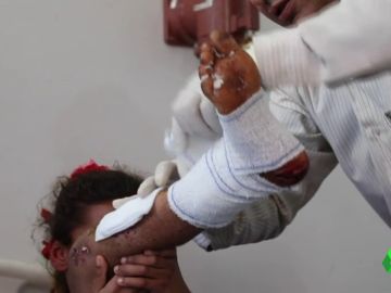 Un niña víctima de una mina antipersona Un niña víctima de una mina antipersona