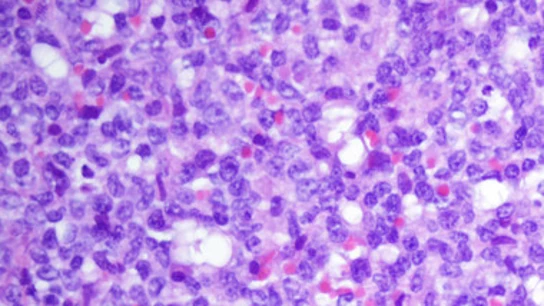 Descifran como funciona el genoma de la leucemia Descifran como funciona el genoma de la leucemia
