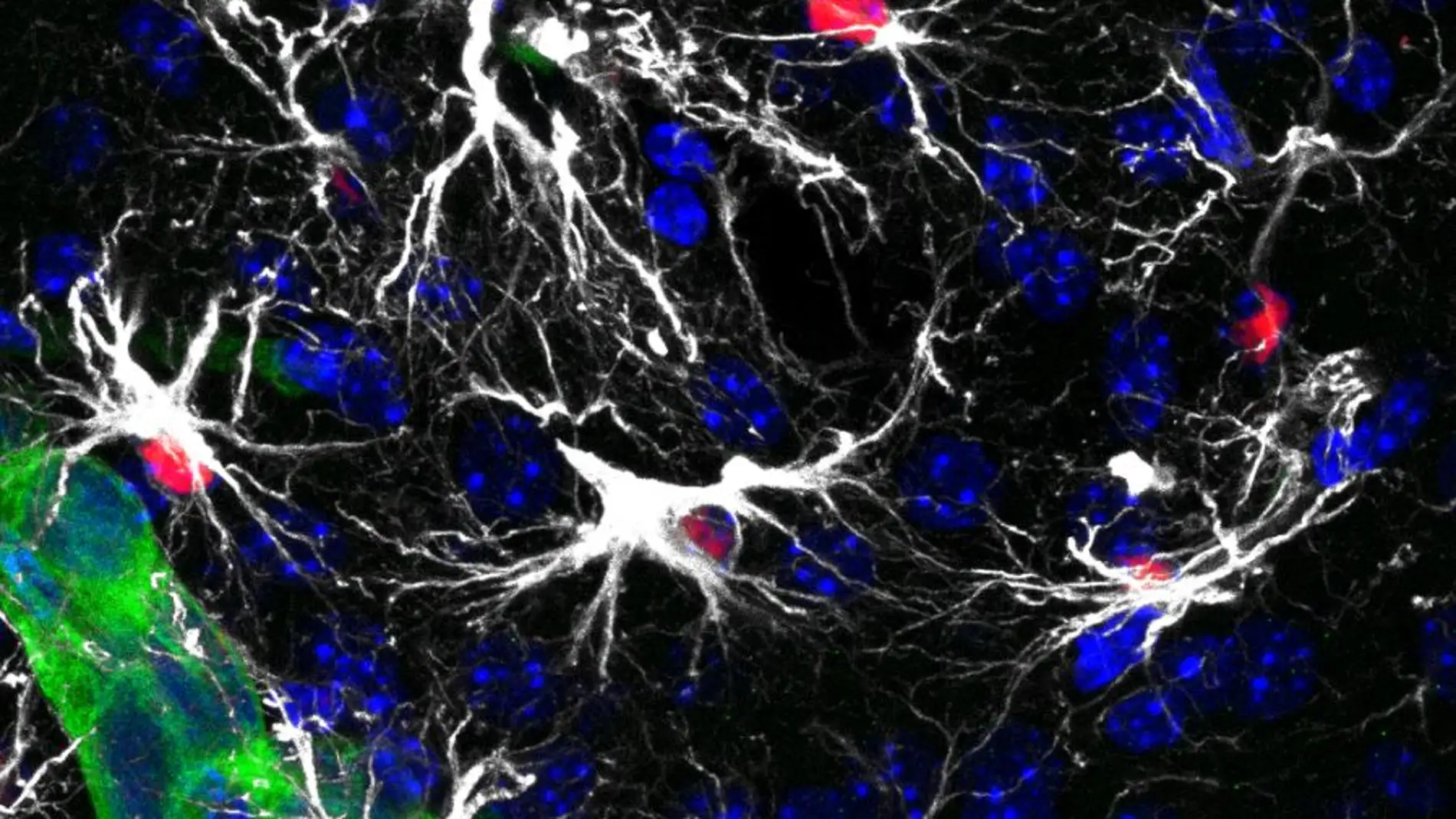 células metastáticas en el cerebro