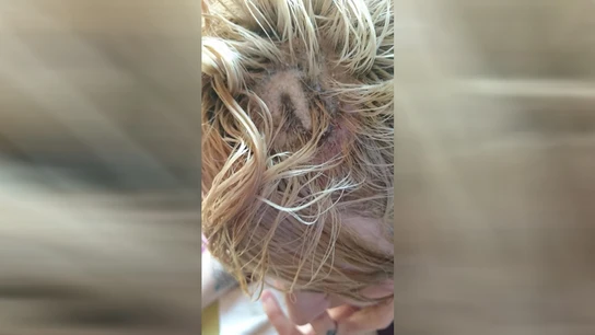 Joven con quemaduras de segundo grado en la cabeza Joven con quemaduras de segundo grado en la cabeza