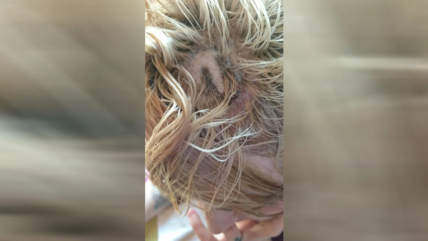 Joven con quemaduras de segundo grado en la cabeza Joven con quemaduras de segundo grado en la cabeza