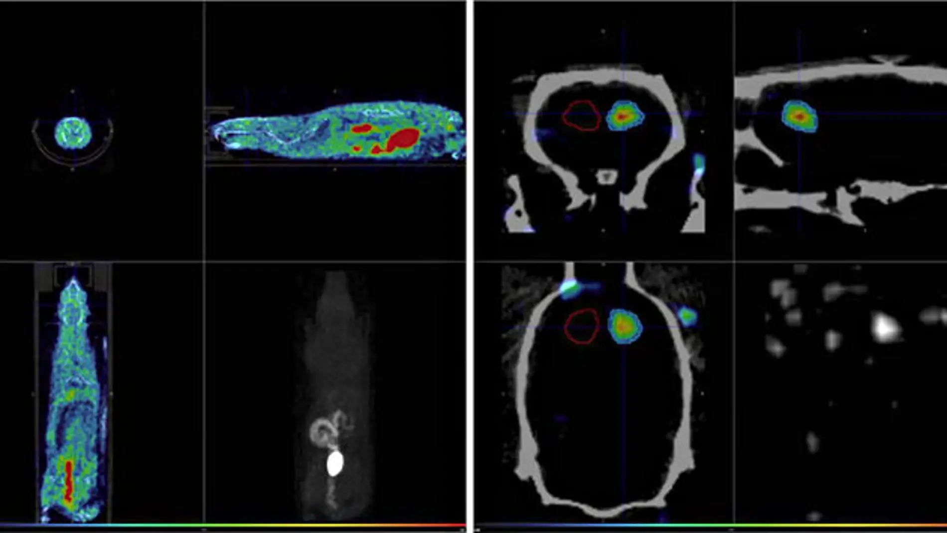 Imagen PET/CT (CNA)