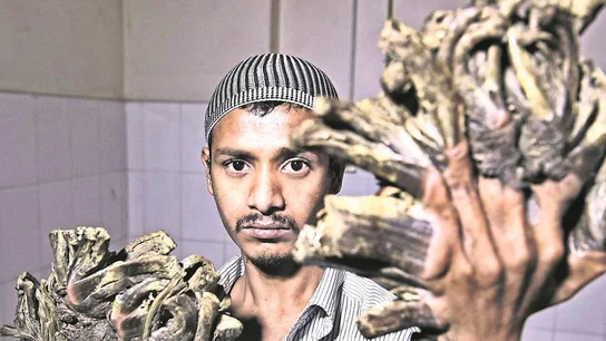 Imagen de Abul Bajandar, más conocido como el 'hombre árbol' Imagen de Abul Bajandar, más conocido como el 'hombre árbol'