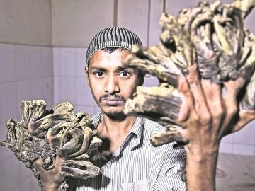 Imagen de Abul Bajandar, más conocido como el 'hombre árbol' Imagen de Abul Bajandar, más conocido como el 'hombre árbol'