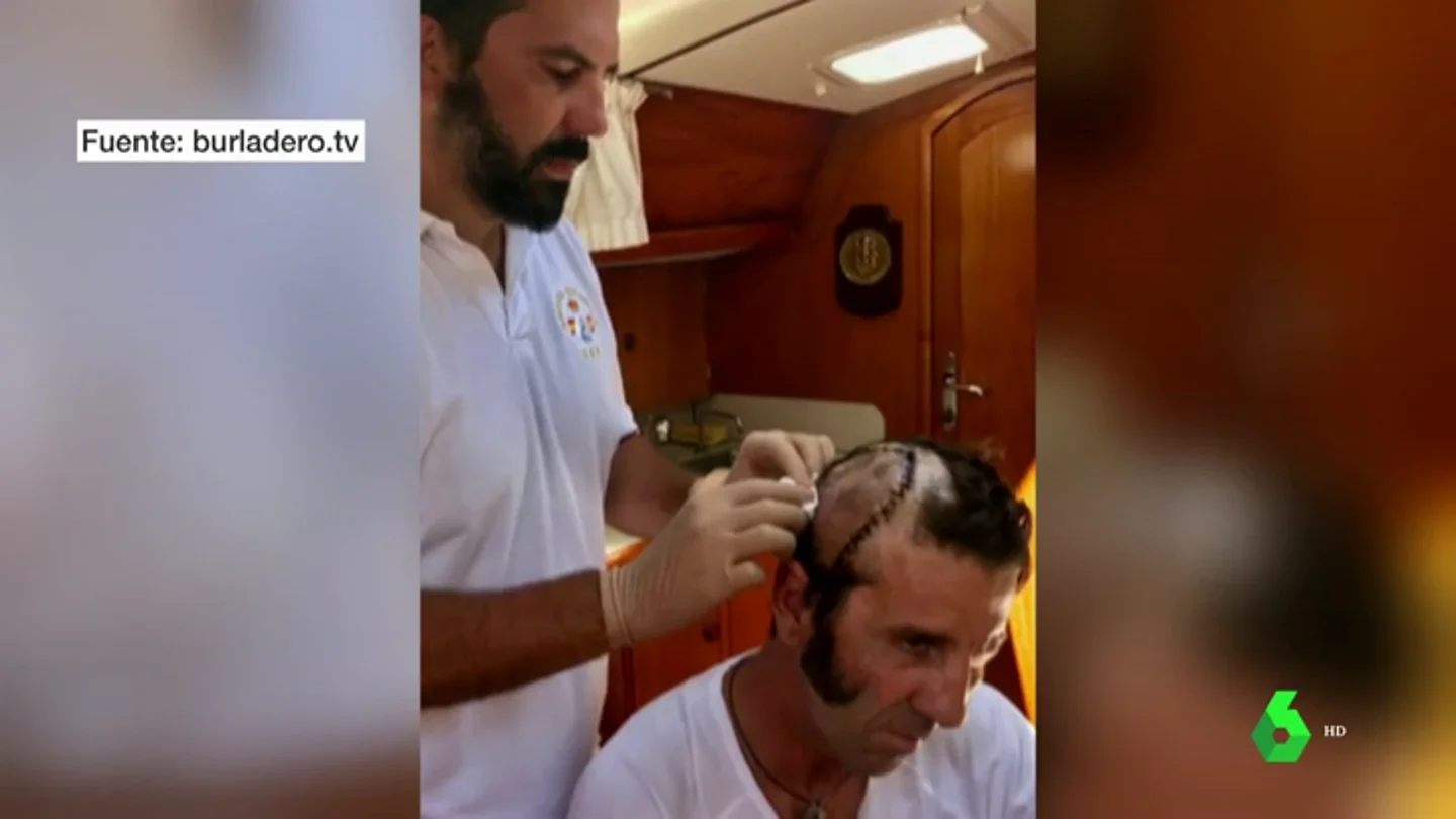 El torero Padilla comparte una foto de los puntos de sutura en su cabeza tras la cornada que recibió El torero Padilla comparte una foto de los puntos de sutura en su cabeza tras la cornada que recibió