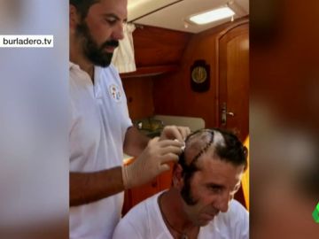 El torero Padilla comparte una foto de los puntos de sutura en su cabeza tras la cornada que recibió 