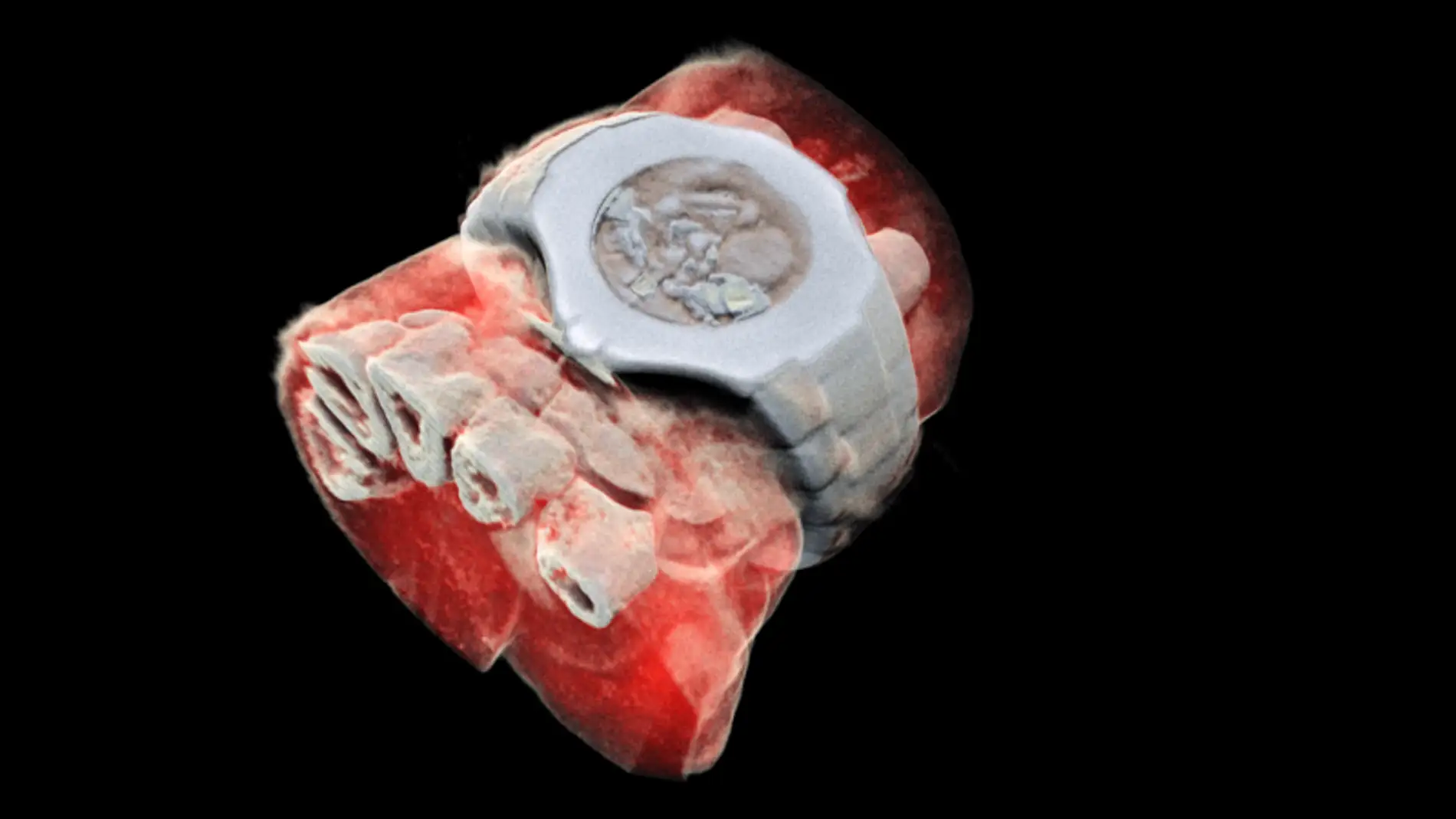 Radiografía a color de una muñeca en la que se aprecian los huesos, los tejidos blandos y hasta un reloj 