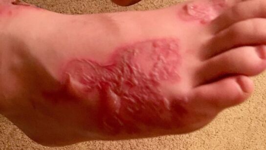 La infecci&oacute;n parasitaria de Michael Dumas