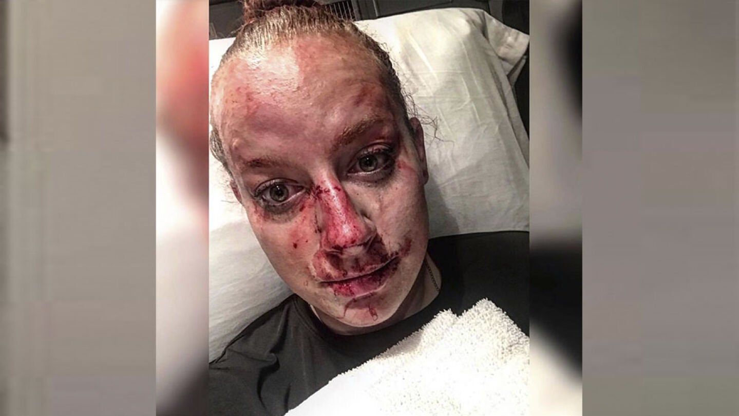 Polic&iacute;a herida tras una pelea con un joven 