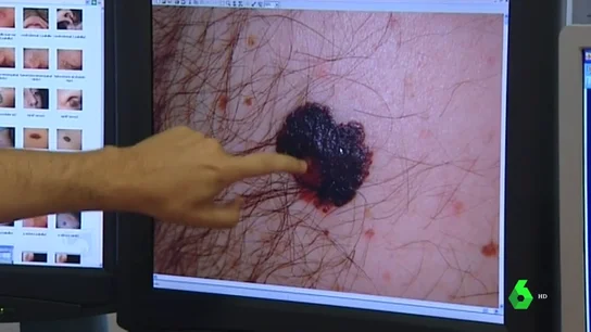 Los malanocitos son las manchas en la piel que aparecen por la radiación solar Los malanocitos son las manchas en la piel que aparecen por la radiación solar