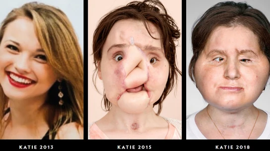 Trasplante de cara de Katie Stubblefield National Geographic