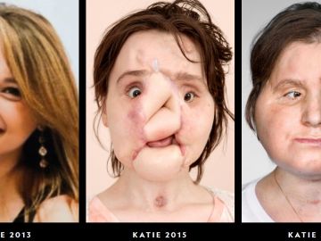 Trasplante de cara de Katie Stubblefield Trasplante de cara de Katie Stubblefield
