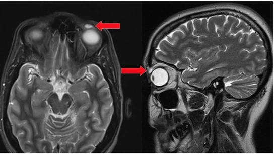 Imagen de la lentilla incrustada en el párpado de la mujer Imagen de la lentilla incrustada en el párpado de la mujer